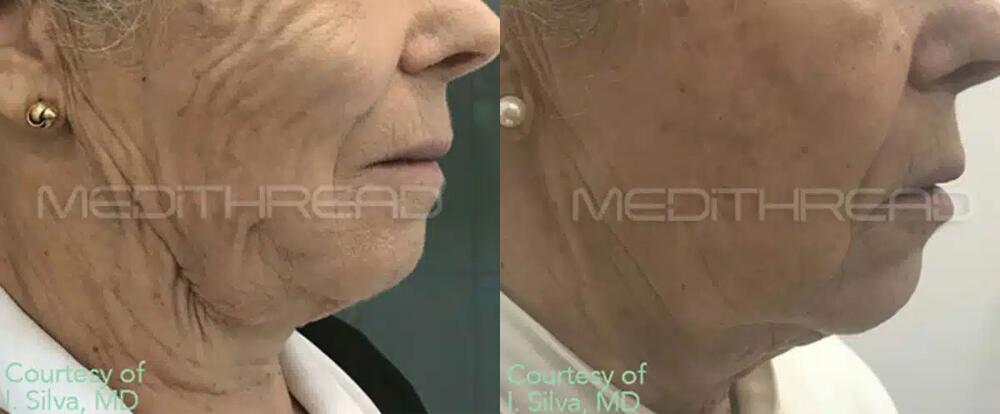 Thread Lift Before & After Image