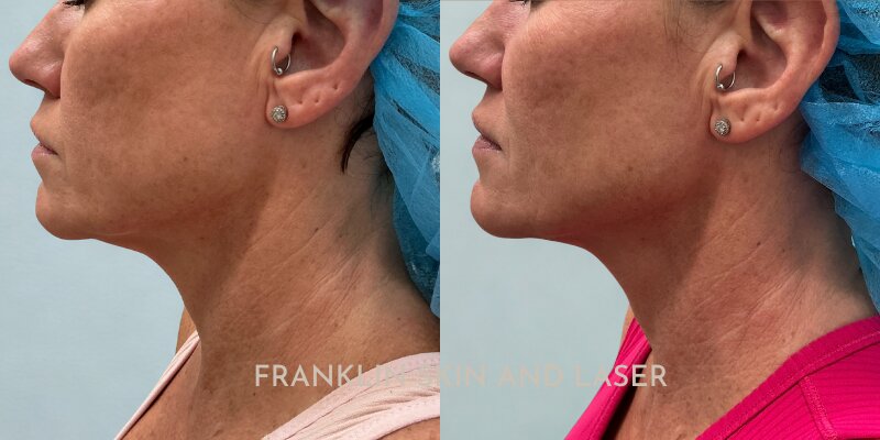 Thread Lift Before & After Image