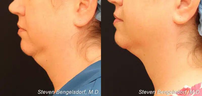 kybella Before & After Image