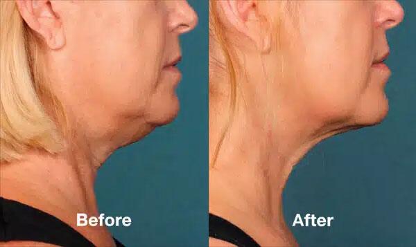 kybella Before & After Image