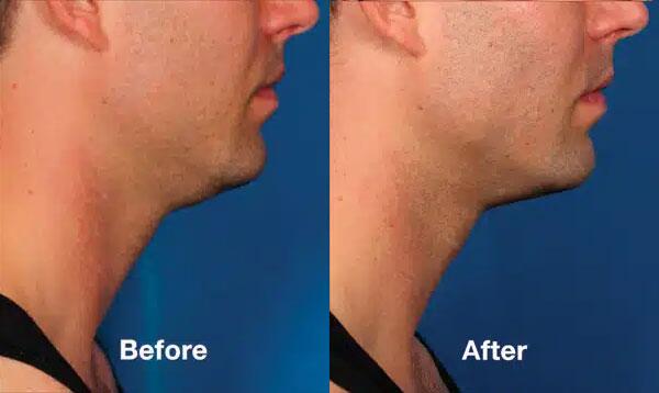 kybella Before & After Image