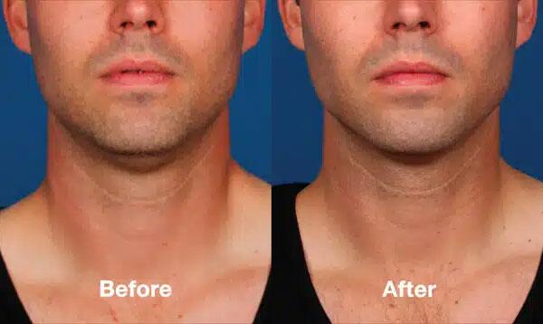 Kybella Before & After Image