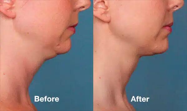 Kybella Before & After Image