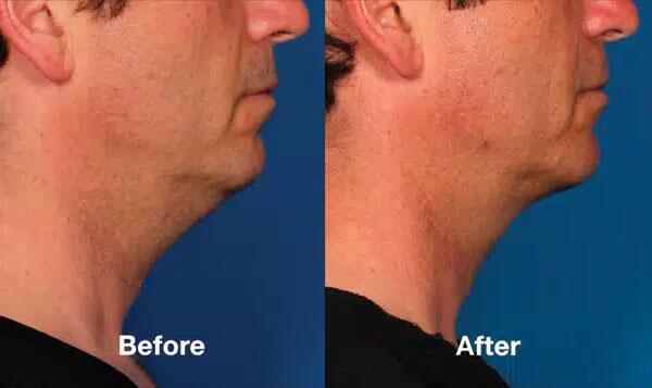 Kybella Before & After Image