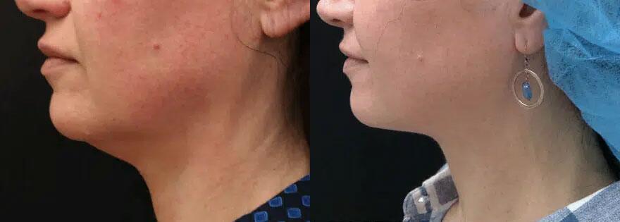 Kybella Before & After Image