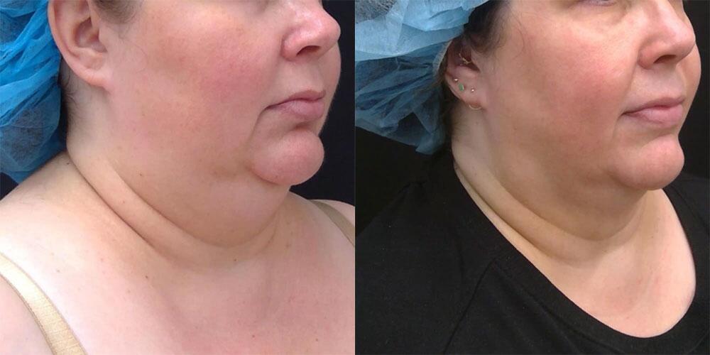 Kybella Before & After Image
