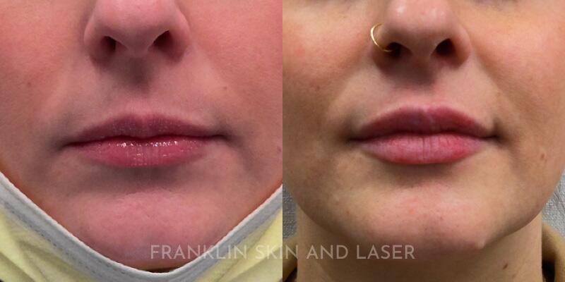 lip filler Before & After Image