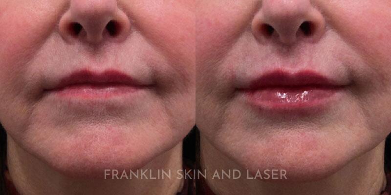 lip filler Before & After Image