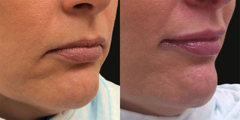 lip filler Before & After Image