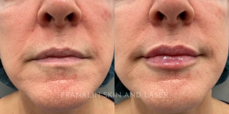lip filler Before & After Image