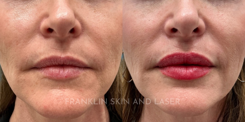 Lip Filler Before & After Image