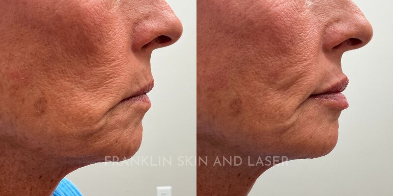 Lip Filler Before & After Image