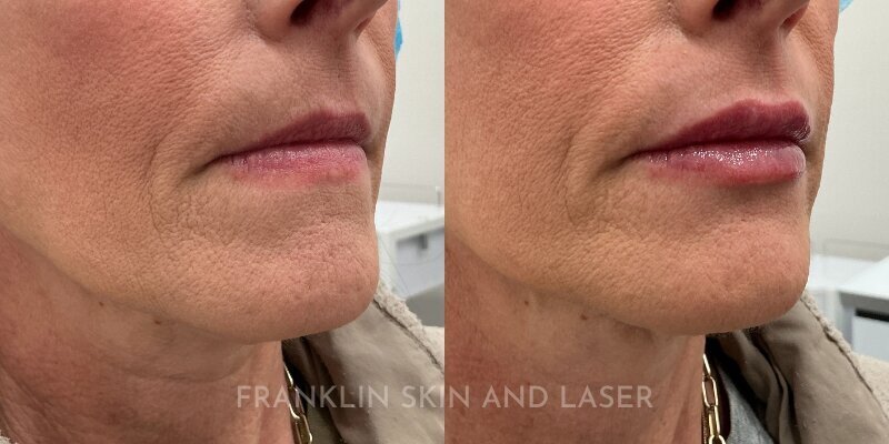 Lip Filler Before & After Image
