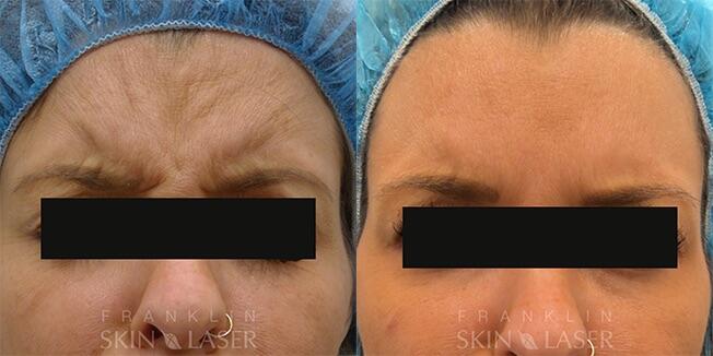 Neuromodulators Before & After Image