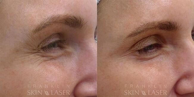 Neuromodulators Before & After Image