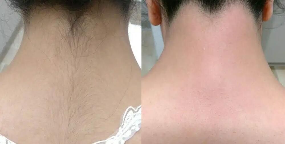 Laser Hair Removal Before & After Image