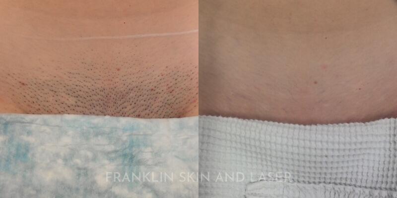 Laser Hair Removal Before & After Image