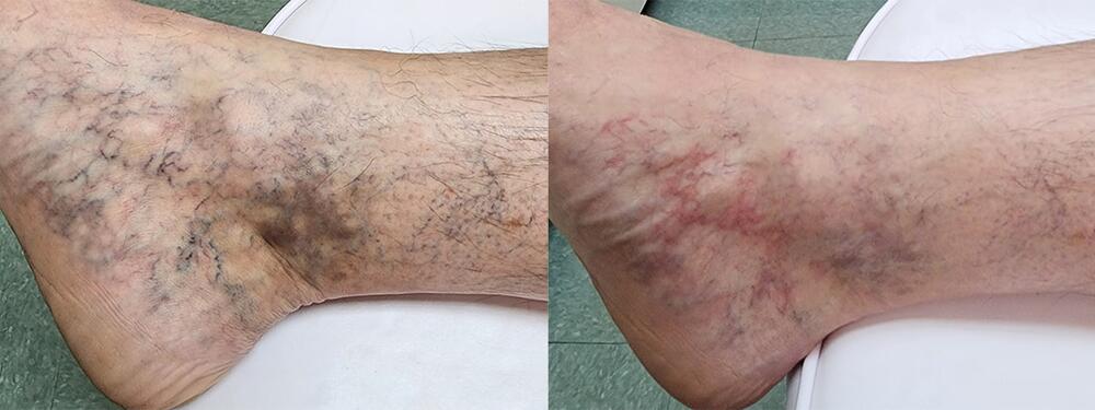 Laser Vein Reduction Before & After Image