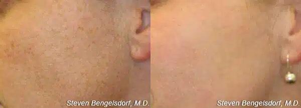 photorejuvenation Before & After Image