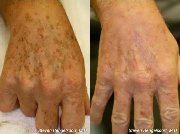 photorejuvenation Before & After Image