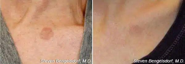 photorejuvenation Before & After Image