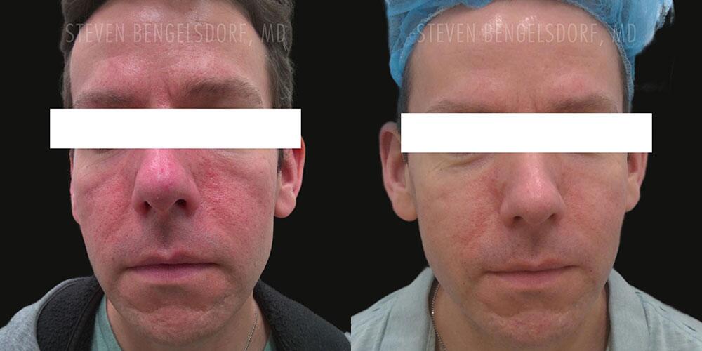 Photorejuvenation Before & After Image