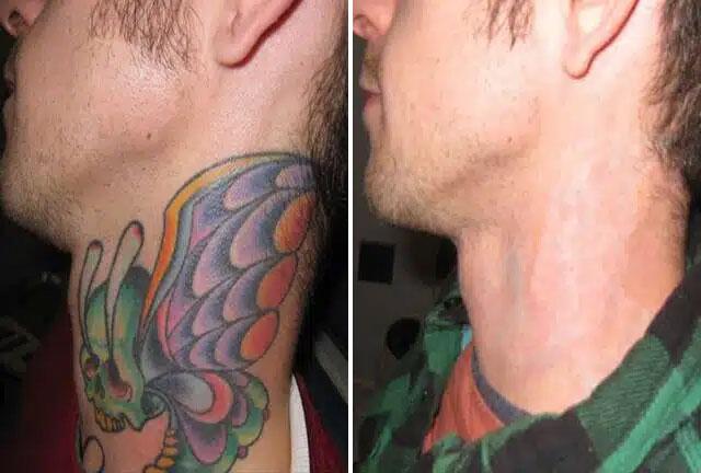 tattoo removal Before & After Image