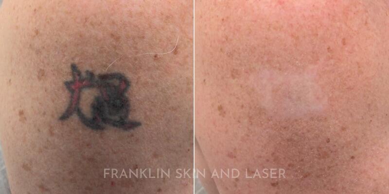 tattoo removal Before & After Image