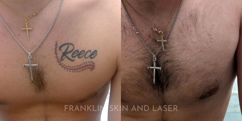 Tattoo Removal Before & After Image