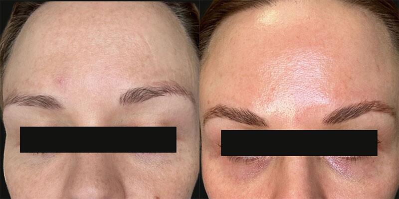 ultraclear Before & After Image