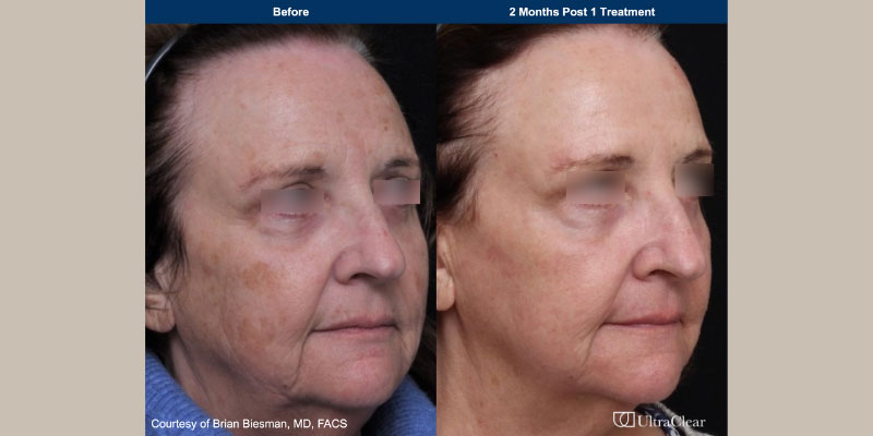 ultraclear Before & After Image