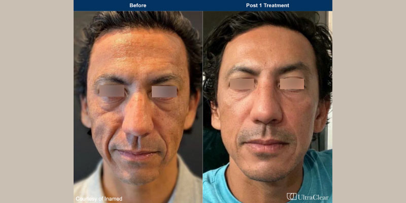 ultraclear Before & After Image